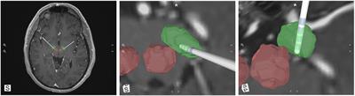 Lead location as a determinant of motor benefit in subthalamic nucleus deep brain stimulation for Parkinson’s disease